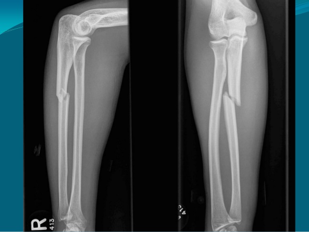 Gãy xương cẳng tay - Hình ảnh minh họa